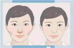 颧骨高怎么拯救?