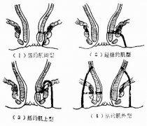 一起来看看肛瘘挂线手术！
