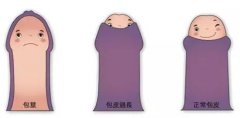 男生都要割包皮？