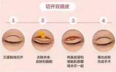医疗整形越发达，可割双眼皮的价钱是如何呢？