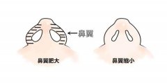 鼻翼缩小改善的方法
