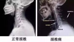 颈椎病的自我治疗方法